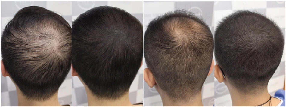 Sonwu Supply Hair Loss Treatment CB-03-01 Powder